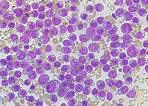 リンパ腫の細胞診