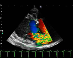 循環器科・僧帽弁閉鎖不全症