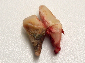 歯科症例・眼下膿瘍